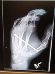 Xray of Isaac's left hand